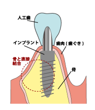 インプラントのイメージ