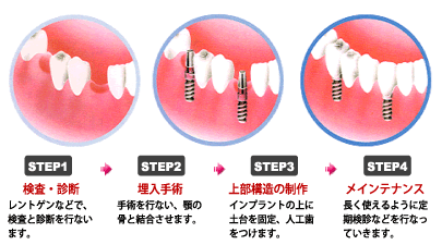 インプラントながれのイメージ