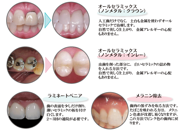 金属の詰め物（銀歯）が笑うと見えるのが嫌だと思われる方、セラミックなどの金属以外の材料使い、患者さんの歯の色に合わせて自然な白さで治療がわからないのが審美歯科治療、１ランク上の治療法により笑顔も美しく。